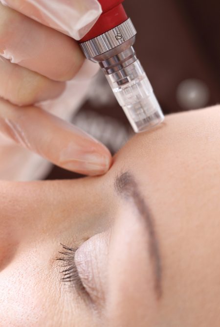 Mesotherapy microneedle, the woman at the beautician