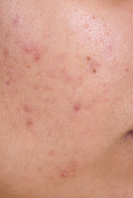 microdermabrasion-for-acne